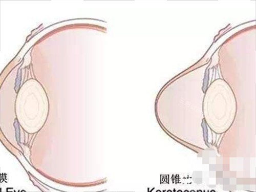 眼角膜前后对比动画展示 眼角膜前后对比动画展示