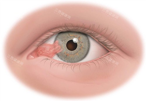 翼状胬肉眼睛 翼状胬肉眼睛