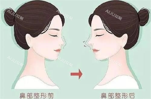 液态隆鼻前后的区别