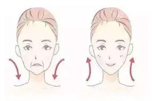 拉皮面部提升对比卡通示意图 拉皮面部提升对比卡通示意图