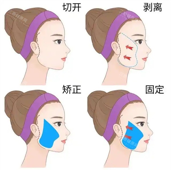 面部拉皮整形手术 面部拉皮整形手术