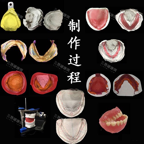 吸附性义齿制作过程示意图