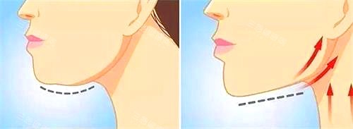 0.8mm悬吊带+网格锚点：李建钢筋膜提升真的有用吗？技术细节决定结果持久度