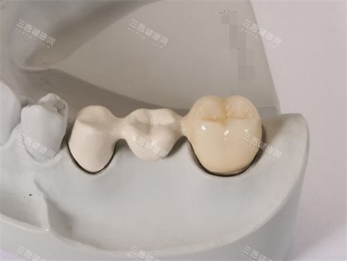 peek支架定制假牙