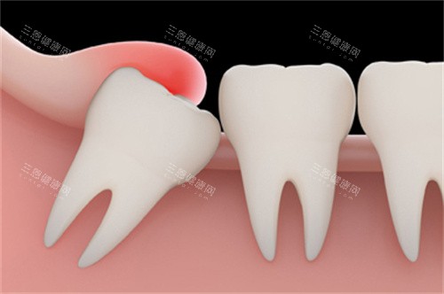智齿萌出牙龈红肿