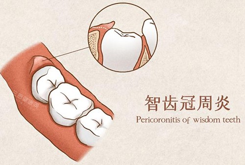 智齿冠周炎漫画示意图