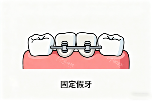 固定假牙卡通展示图 固定假牙卡通展示图