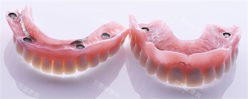 3分钟说清：吸附性义齿和普通义齿的区别（适用人群/舒适度/成本必看）