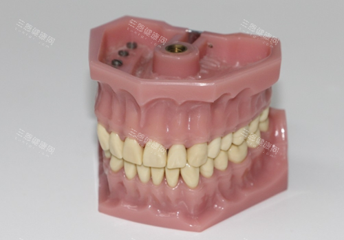 全口假牙 全口假牙