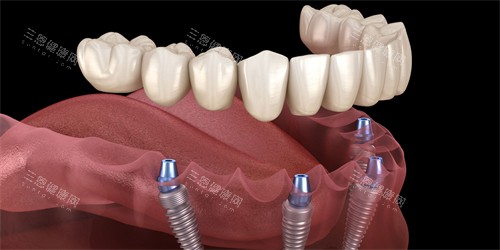 国产种植牙十大品牌PK：谁的骨结合更快？谁的稳定性最强？实测数据说话