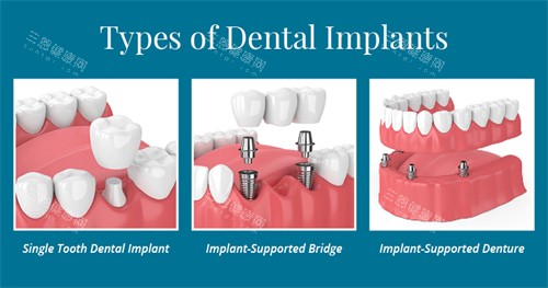 不同种植牙方式展示 不同种植牙方式展示