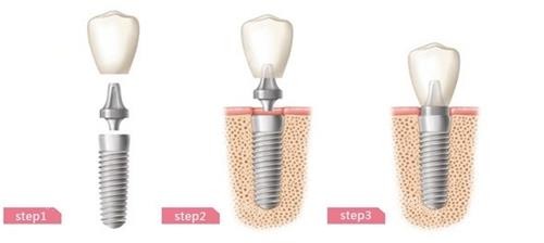 口腔医生推荐：2026值得选的国产种植牙品牌，这4个临床用得更多