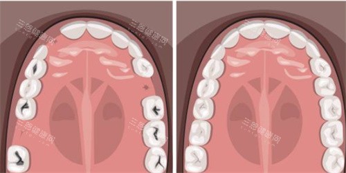 牙齿缺失补牙示意图 牙齿缺失补牙示意图