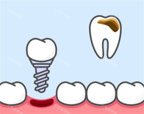 牙齿坏了换种植牙 牙齿坏了换种植牙
