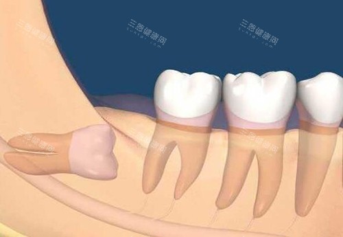 牙齿阻生智齿卡通图 牙齿阻生智齿卡通图