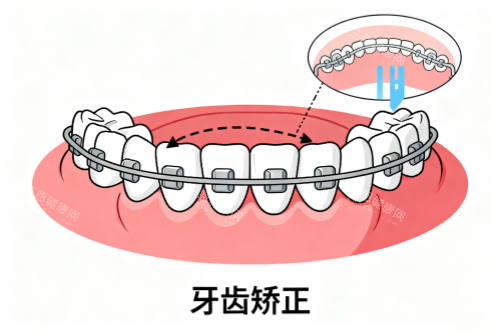 牙齿矫正卡通图片一览 牙齿矫正卡通图片一览