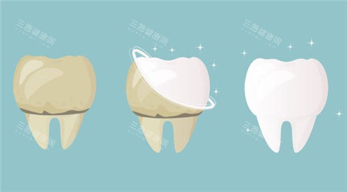 牙齿清洗前后对比 牙齿清洗前后对比