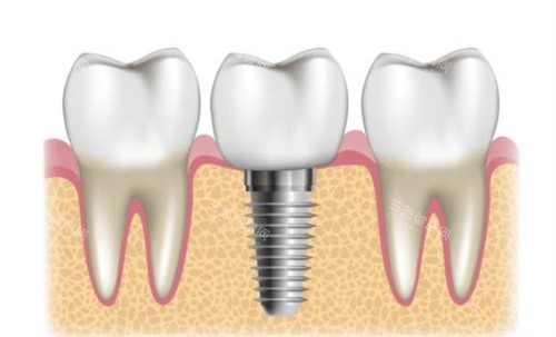 种植牙周围健康牙 种植牙周围健康牙