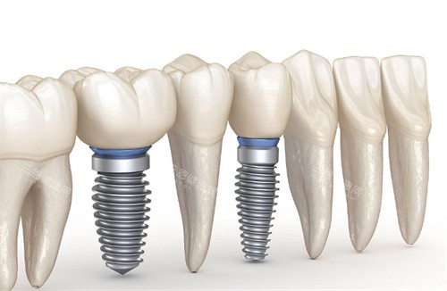 种植牙动画图片展示 种植牙动画图片展示