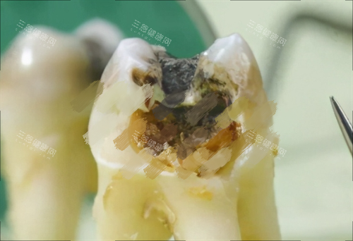 烂牙齿图片展示 烂牙齿图片展示