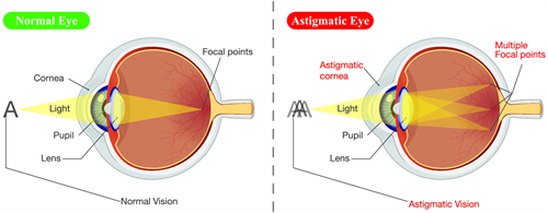 散光眼睛看不清楚东西的原理 散光眼睛看不清楚东西的原理