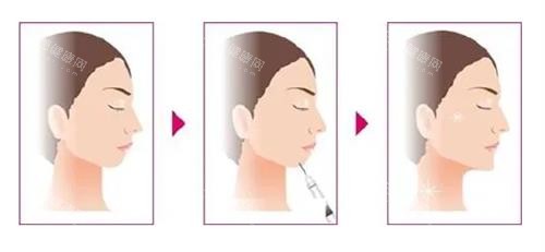 玻尿酸丰下巴前后的区别 玻尿酸丰下巴前后的区别