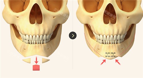 下巴整形环骨骼变化图 下巴整形环骨骼变化图