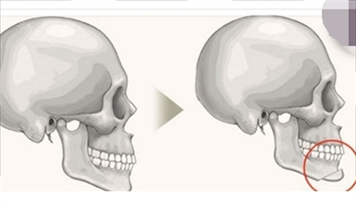下巴截骨骨骼剖面图 下巴截骨骨骼剖面图
