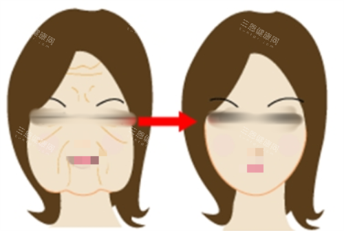 打针瘦脸前后对比图 打针瘦脸前后对比图