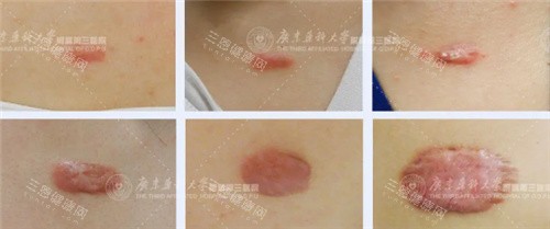 疤痕疙瘩图示 疤痕疙瘩图示
