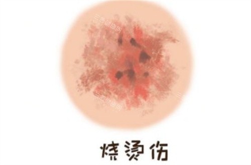 烧烫伤疤痕 烧烫伤疤痕