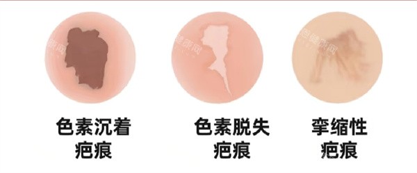 疤痕图片 疤痕图片