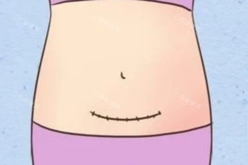 剖腹产疤痕图 剖腹产疤痕图