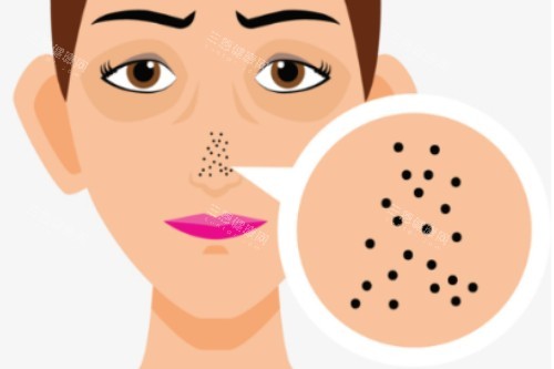 鼻子毛孔粗大卡通图 鼻子毛孔粗大卡通图