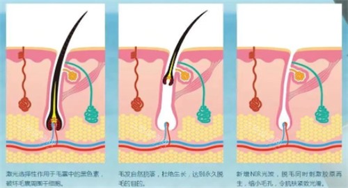 光子脱毛前后变化 光子脱毛前后变化
