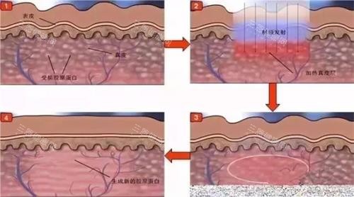 光子嫩肤的步骤 光子嫩肤的步骤