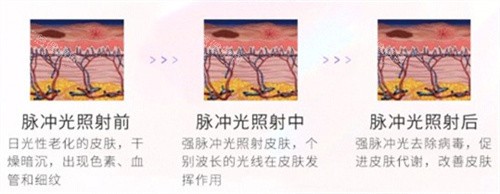 光子嫩肤对比 光子嫩肤对比