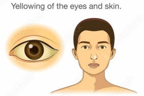 眼睛发黄 眼睛发黄