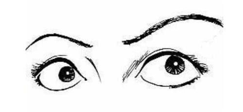 眼睛外凸示意图 眼睛外凸示意图