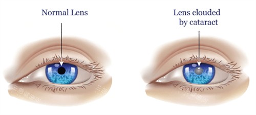 正常眼睛和白内障眼睛的区别 正常眼睛和白内障眼睛的区别