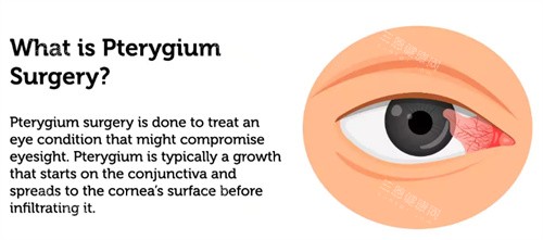 什么是眼睛翼状胬肉 什么是眼睛翼状胬肉