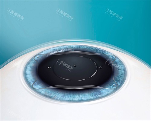 人工晶体植入眼睛后图示 人工晶体植入眼睛后图示