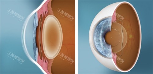 人工晶体植入眼睛对比 人工晶体植入眼睛对比