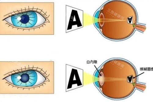 白内障和正常眼睛卡通对比一览图 白内障和正常眼睛卡通对比一览图