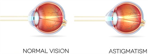 正常眼镜和散光眼睛区别 正常眼镜和散光眼睛区别