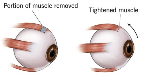 重庆西南医院眼科做视网膜手术有多强？专科修复团队，术后结果超赞！