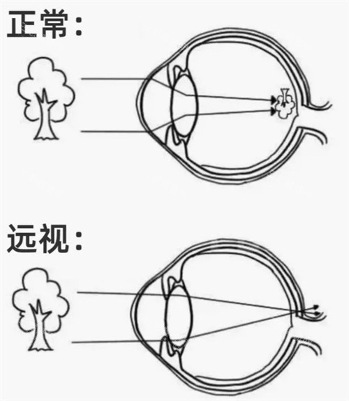 正常眼镜和远视眼睛