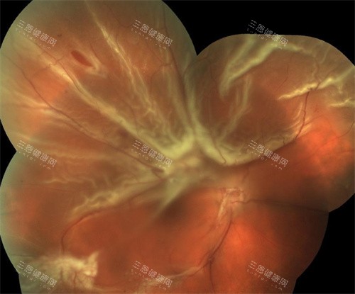 爱尔眼科能做视网膜脱落手术吗？当然可以！技术成熟，术后修复快，放心选择！