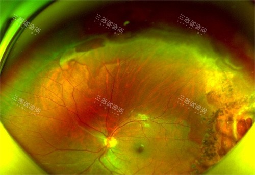 孔源性视网膜脱离细节图 孔源性视网膜脱离细节图