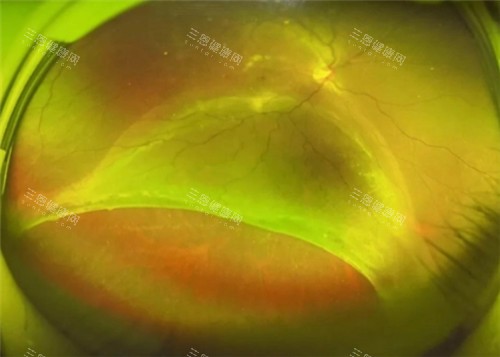 视网膜脱落图片 视网膜脱落图片